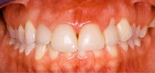 crown-lengthening-before-village-dental crown-lengthening-before-village-dental