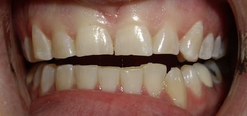 crowns-bonding-before-village-dental crowns-bonding-before-village-dental