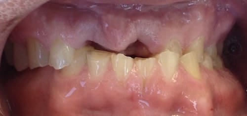 implants-front-before-village-dental implants-front-before-village-dental