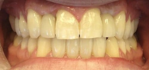 implants-invisalign-after-village-dental implants-invisalign-after-village-dental