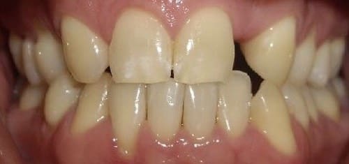 implants-invisalign-before-village-dental.jpeg implants-invisalign-before-village-dental.jpeg