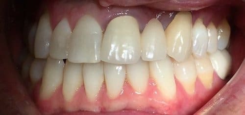 teeth-in-a-day-before-village-dental teeth-in-a-day-before-village-dental